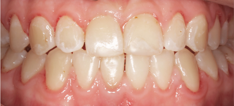 Исправление мезиального прикуса с помощью элайнеров Invisalign и минивинтов