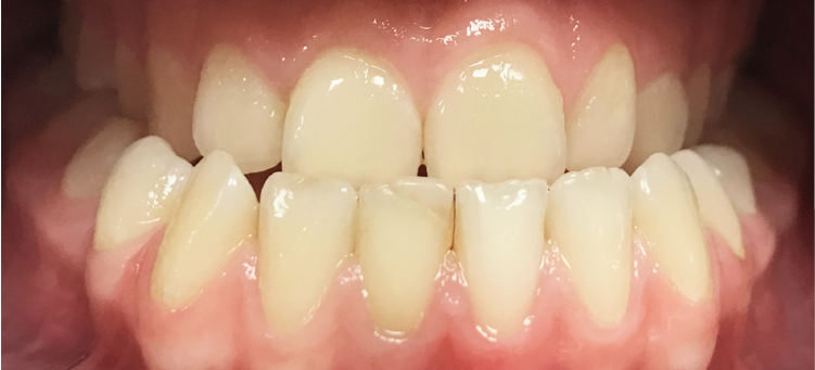 Исправление мезиального прикуса с помощью элайнеров Invisalign и минивинтов