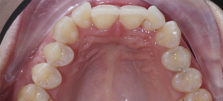Изменение скученности зубов с помощью системы Invisalign