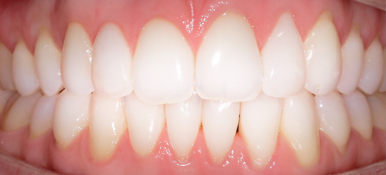 Выравнивание зубных рядов элайнерами Invisalign
