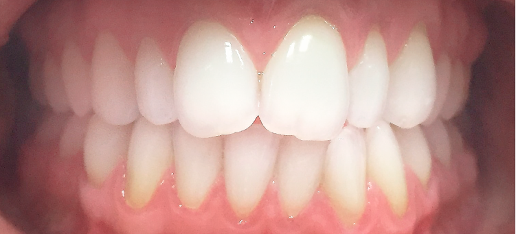 Выравнивание зубных рядов элайнерами Invisalign