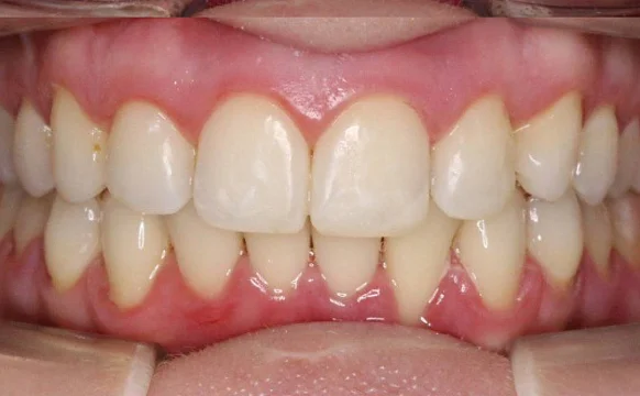 Лечение скученности зубов на элайнерах