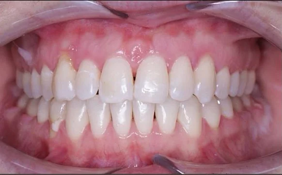 Лечение прикуса на брекет-системе