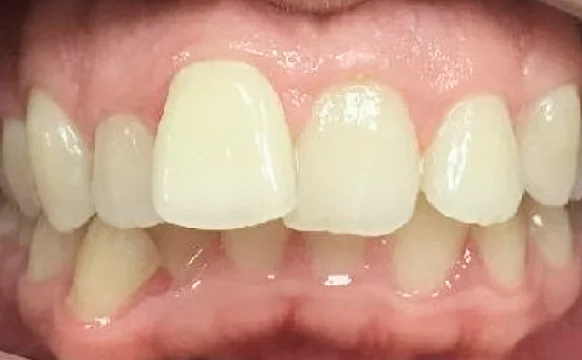 Устранение протрузии верхних резцов