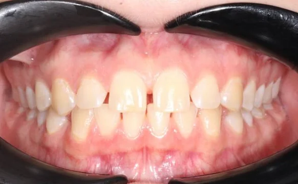 Лечение диастемы на верхней челюсти на элайнерах Click