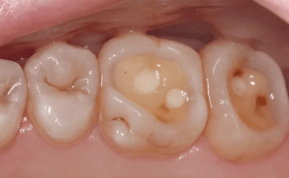 Восстановление эстетики с помощью виниров и вкладок (часть 2)