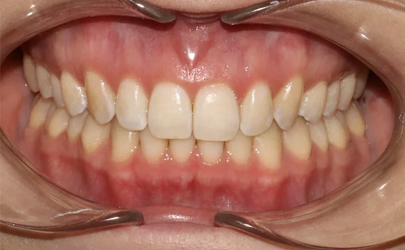 Ортодонтическое лечение на элайнерах №9