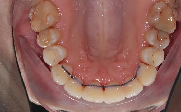 Лечение на Invisalign