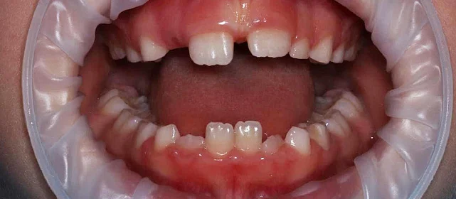 Детская профилактическая гигиена полости рта