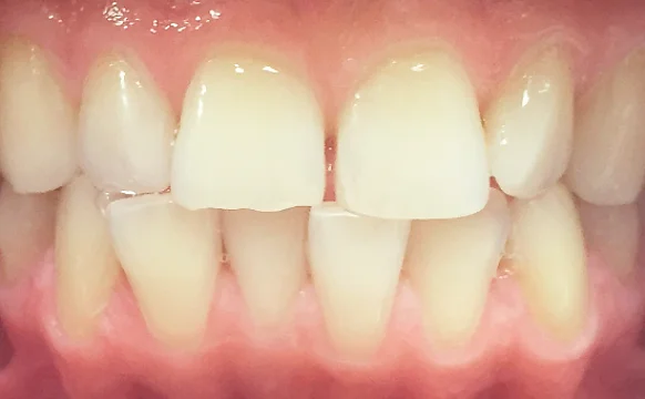 Исправление прикуса элайнерами Инвизилайн