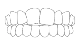 Скученность зубов