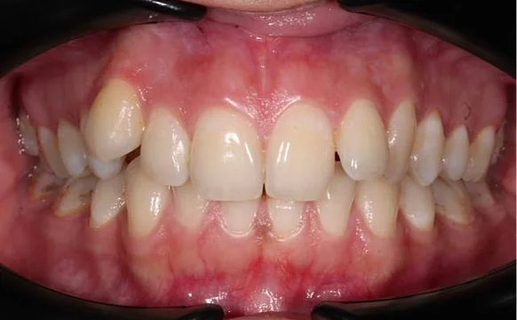 Ортодонтическое лечение на брекет-системе №2