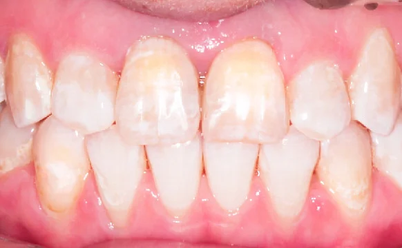 Исправление прикуса. 38 кап, 19 месяцев лечения