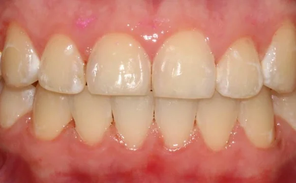 Ортодонтическое лечение на брекет-системе №3