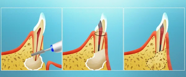 хирургическое лечение периодонтита