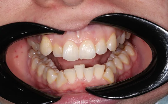 Лечение аномалии соотношения зубных дуг элайнерами