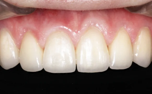 Протезирование зубов верхней челюсти винирами