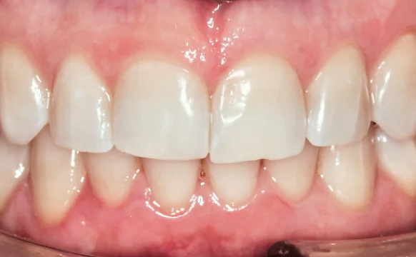 Исправление прикуса. 27 кап, 14 месяцев лечения