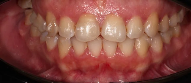 Эстетическая реставрация передних зубов