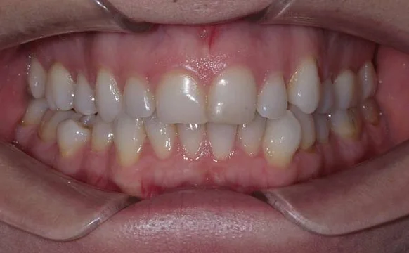 Лечение неправильного прикуса элайнерами