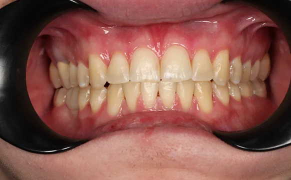 Лечение аномалии соотношений зубных дуг на брекет-системе