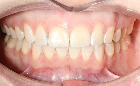 Коррекция дистального прикуса элайнерами