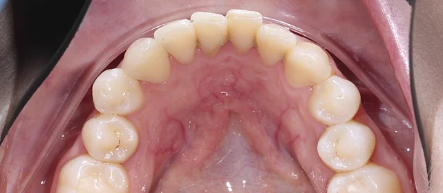 Расширение зубных рядов