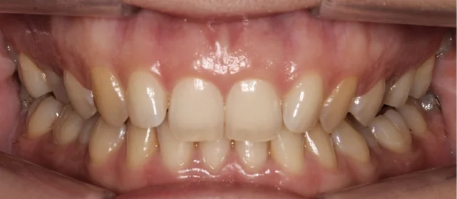 Ортодонтическое лечение на элайнерах №9