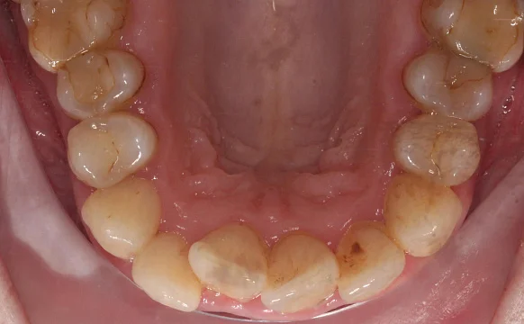 Лечение на Invisalign