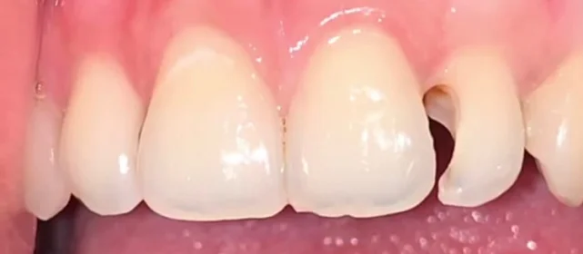 Реставрация зуба