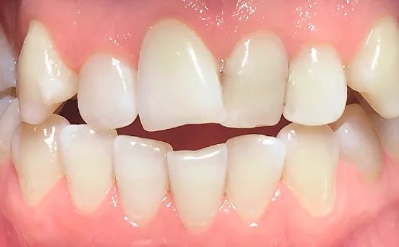 Лечение прикуса с последующей ортопедией верхних зубов