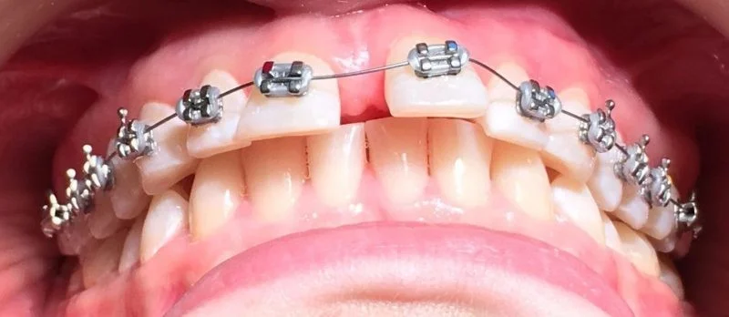 лечение брекетами