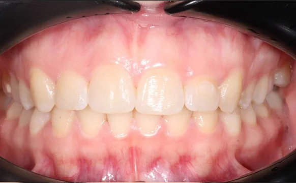 Лечение cкученности на нижней челюсти на элайнерах