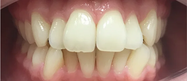 Исправление фронтальной группы зубов капами Инвизилайн