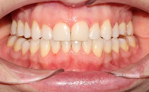 Лечение неправильного прикуса элайнерами