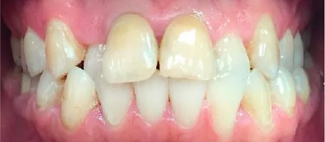 Исправление прикуса. 38 кап, 19 месяцев лечения