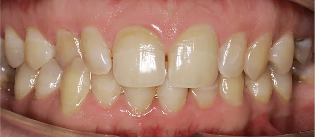 Ортодонтическая подготовка зубов к предстоящим ортопедии и имплантации