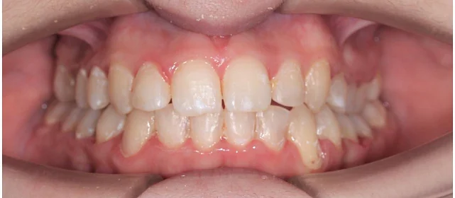 Ортодонтическое лечение на элайнерах №3