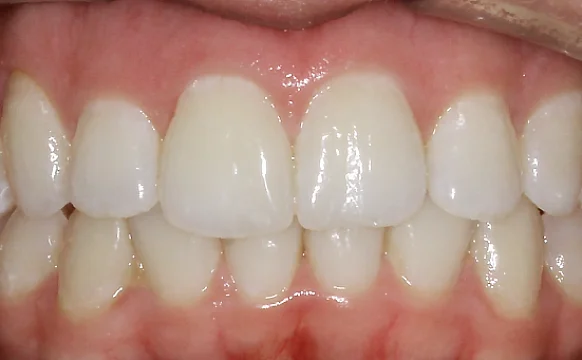 Устранение протрузии верхних резцов