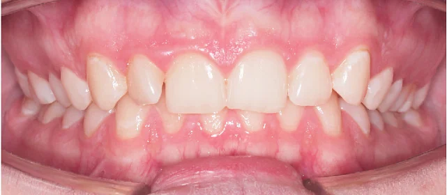 Исправление прикуса. 29 кап, 7 месяцев лечения