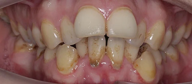 Исправление скученности элайнерами