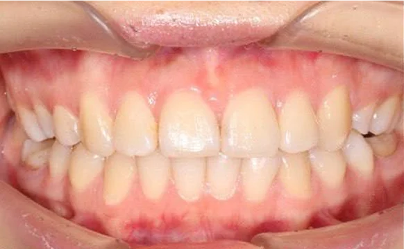 Ортодонтическое лечение на брекет-системе №1