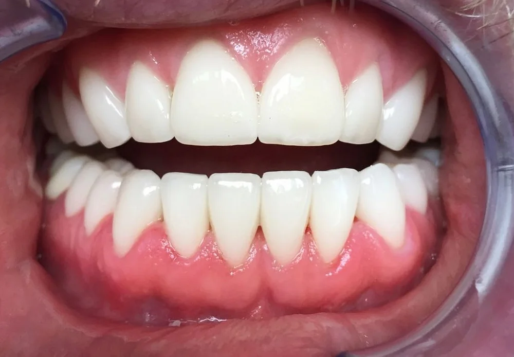 реабилитация после установки виниров