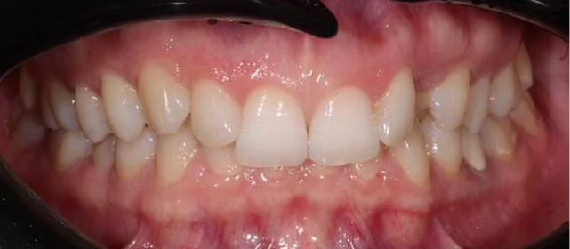 Коррекция дистальной окклюзия на брекет-системе