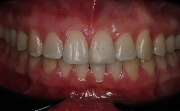 Лечение дистальной окклюзии на брекет-системе