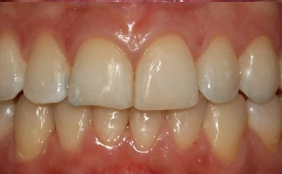 Ортодонтическое лечение на элайнерах №7