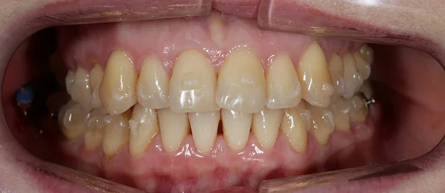 Ортодонтическое лечение на элайнерах