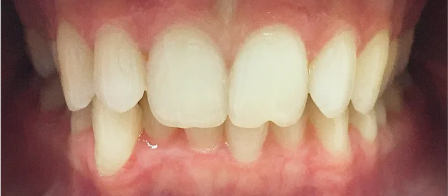 Лечение ретрузионного наклона верхних резцов с последующей реставрацией