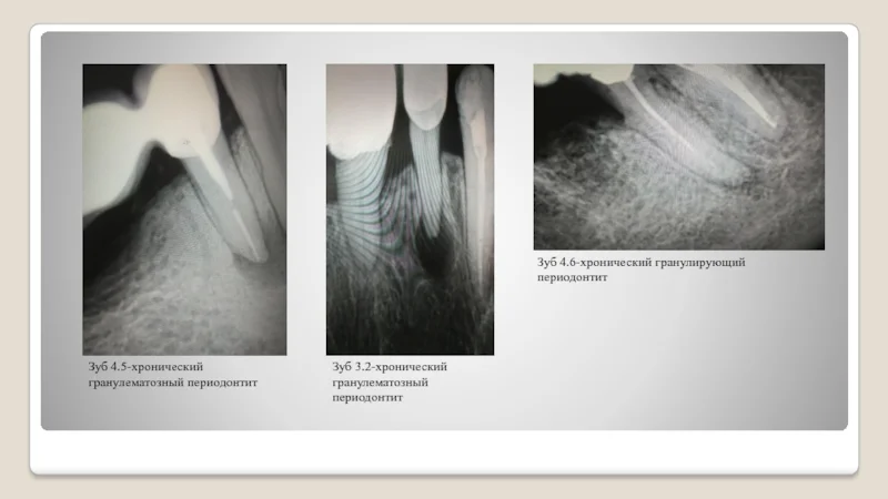периодонтит - изображение 2