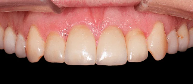 Восстановление эстетики с помощью виниров и вкладок (часть 1)